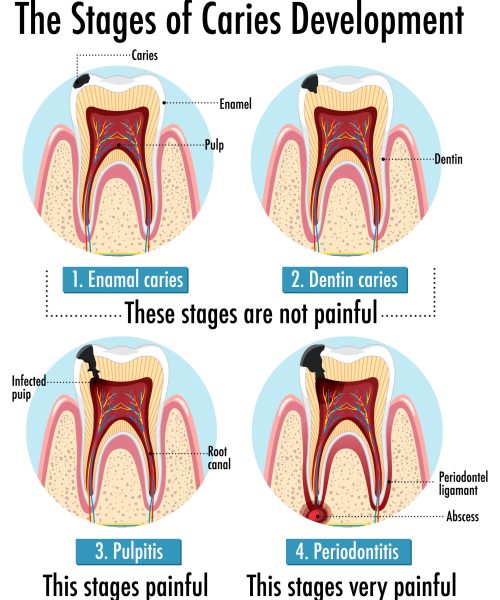 Infographic of human in the stages of caries development Infographic of human in the stages of caries development illustration